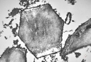  bone marrow … plasmocytoma (parafin-embedded sample)